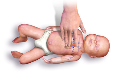 סכמת החייאה CPR תינוק
